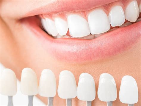 composite teeth veneers|Composite Veneers (Pros, Cons & Costs) .